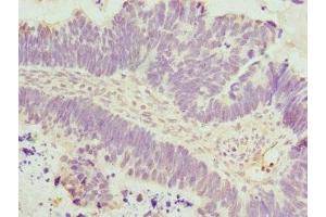 Immunohistochemistry of paraffin-embedded human ovarian cancer using ABIN7150033 at dilution of 1:100 (DAAM2 antibody  (AA 1-86))