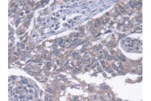 Detection of ERLIN2 in Human Lung cancer Tissue using Polyclonal Antibody to Endoplasmic Reticulum Lipid Raft Associated Protein 2 (ERLIN2) (ERLIN2 antibody  (AA 47-339))