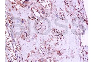 Formalin-fixed and paraffin embedded human placenta tissue labeledwith Anti-Phospho-Estrogen Receptor alpha (Ser167) Polyclonal Antibody, Unconjugated (ABIN729493) at 1:200, followed by conjugation to the secondary antibody and DAB staining