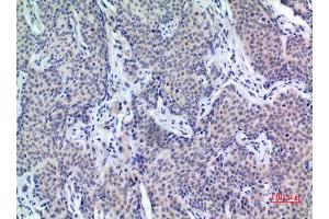 Immunohistochemistry (IHC) analysis of paraffin-embedded Human Mammary Cancer, antibody was diluted at 1:100. (PDGFD antibody  (C-Term))