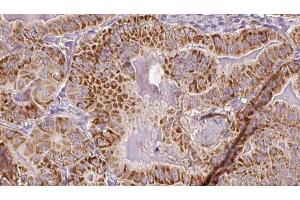 ABIN6267088 at 1/100 staining Human thyroid cancer tissue by IHC-P.