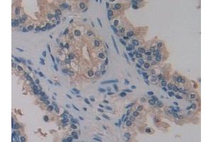 Detection of PTI in Human Prostate Tissue using Polyclonal Antibody to Placental Thrombin Inhibitor (PTI) (SERPINB6 antibody  (AA 1-376))
