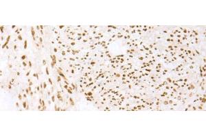 Immunohistochemistry of paraffin-embedded Human liver cancer tissue using TCOF1 Polyclonal Antibody at dilution of 1:50(x200) (TCOF1 antibody)
