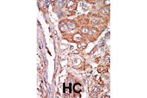Formalin-fixed and paraffin-embedded human hepatocellular carcinoma tissue reacted with FGF4 polyclonal antibody  , which was peroxidase-conjugated to the secondary antibody, followed by DAB staining. (FGF4 antibody  (C-Term))