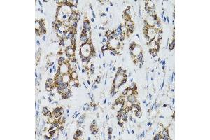 Immunohistochemistry of paraffin-embedded human colon carcinoma using SURF1 antibody. (SURF1 antibody  (AA 80-275))