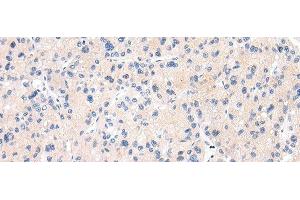 Immunohistochemistry of paraffin-embedded Human liver cancer tissue using MUC7 Polyclonal Antibody at dilution 1:30 (MUC7 antibody)