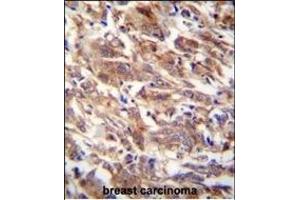 FBXW12 Antibody (C-term) (ABIN654226 and ABIN2844060) immunohistochemistry analysis in formalin fixed and paraffin embedded human breast carcinoma followed by peroxidase conjugation of the secondary antibody and DAB staining. (FBXW12 antibody  (C-Term))