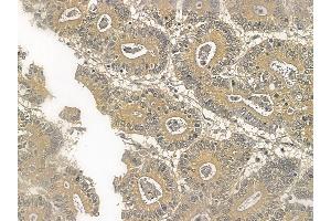 PKC alpha Mouse Monoclonal Antibody at 1/100 staining human colorectal cancer by IHC-P.