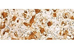Immunohistochemistry of paraffin-embedded Human liver cancer tissue using C11orf54 Polyclonal Antibody at dilution of 1:50(x200) (C11orf54 antibody)