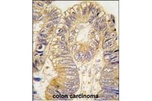Formalin-fixed and paraffin-embedded human colon carcinoma tissue reacted with CLIC5 antibody (ABIN391843 and ABIN2841681) , which was peroxidase-conjugated to the secondary antibody, followed by DAB staining. (CLIC5 antibody)