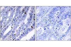 Immunohistochemistry analysis of paraffin-embedded human colon carcinoma tissue, using PKA-R2 beta (Ab-113) Antibody. (PRKAR2B antibody  (AA 79-128))