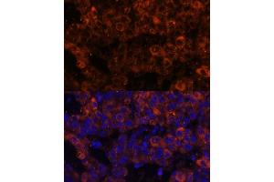 Immunofluorescence analysis of human liver cancer using PAI-1/Serpin E1 Polyclonal Antibody (ABIN6131330, ABIN6147601, ABIN6147603 and ABIN6221802) at dilution of 1:100 (40x lens).