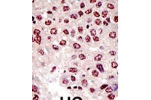 Formalin-fixed and paraffin-embedded human cancer tissue reacted with the primary antibody, which was peroxidase-conjugated to the secondary antibody, followed by AEC staining. (UBE4B antibody  (N-Term))