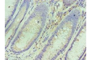 Immunohistochemistry of paraffin-embedded human colon cancer using ABIN7156763 at dilution of 1:100 (IL1RN antibody  (AA 22-230))