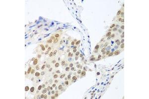 Immunohistochemistry of paraffin-embedded human lung cancer using BCAS2 antibody. (BCAS2 antibody  (AA 1-225))