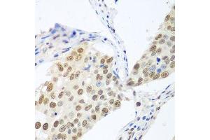 Immunohistochemistry of paraffin-embedded human lung cancer using BCAS2 antibody.