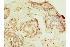 Immunohistochemistry of paraffin-embedded human breast cancer using ABIN7155221 at dilution of 1:100 (HPCAL1 antibody  (AA 2-193))