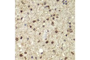 Immunohistochemistry of paraffin-embedded human brain cancer using POU5F1 antibody (ABIN5975856) at dilution of 1/100 (40x lens). (OCT4 antibody)
