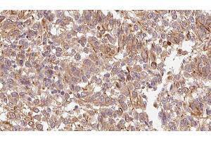 ABIN6278314 at 1/100 staining Human Melanoma tissue by IHC-P. (LEFTY2 antibody  (Internal Region))