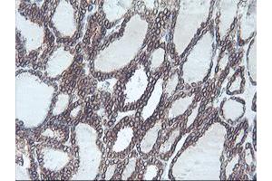 Immunohistochemical staining of paraffin-embedded Carcinoma of Human thyroid tissue using anti-C20orf3 mouse monoclonal antibody. (APMAP antibody)