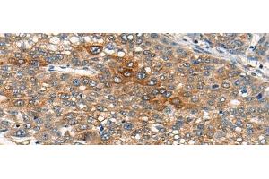 Immunohistochemistry of paraffin-embedded Human liver cancer tissue using B4GAT1 Polyclonal Antibody at dilution of 1:110(x200) (B3GNT1 antibody)