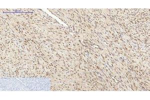 Immunohistochemistry of paraffin-embedded Human uterus cancer tissue using HSP70 Monoclonal Antibody at dilution of 1:200. (HSP70 antibody)