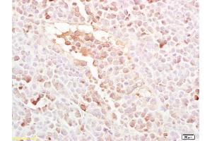 Formalin-fixed and paraffin embedded mouse colon carcinoma labeled with Rabbit Anti LRP5 Polyclonal Antibody, Unconjugated (ABIN754078) at 1:200 followed by conjugation to the secondary antibody and DAB staining (LRP5 antibody  (AA 501-600))