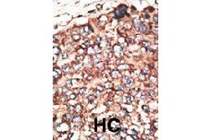 Formalin-fixed and paraffin-embedded human hepatocellular carcinoma tissue reacted with MMP17 polyclonal antibody  , which was peroxidase-conjugated to the secondary antibody, followed by DAB staining. (MMP17 antibody  (Internal Region))