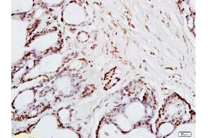 Formalin-fixed and paraffin embedded human colon carcinoma tissue labeled with Anti-FRA2/FOSL2 Polyclonal Antibody, Unconjugated  at 1:200 followed by conjugation to the secondary antibody and DAB staining