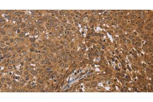 Immunohistochemistry of paraffin-embedded Human cervical cancer using FKBP8 Polyclonal Antibody at dilution of 1:50 (FKBP8 antibody)