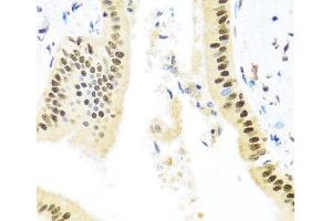 Immunohistochemistry of paraffin-embedded Human liver damage using ZBTB17 Polyclonal Antibody at dilution of 1:100 (40x lens). (ZBTB17 antibody)