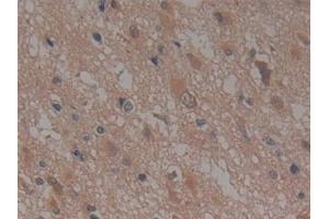 Detection of NUP155 in Human Glioma Tissue using Polyclonal Antibody to Nucleoporin 155 (NUP155)