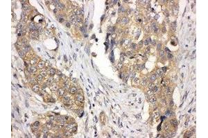 IHC-P: LASP1 antibody testing of human lung cancer tissue (LASP1 antibody  (AA 16-30))