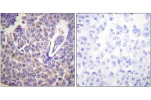 Immunohistochemistry analysis of paraffin-embedded human breast carcinoma, using Calnexin (Phospho-Ser583) Antibody.