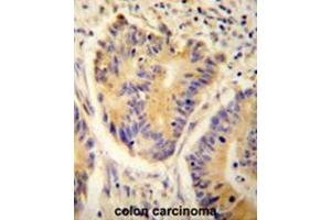 ADH4 antibody(C-term) immunohistochemistry analysis in formalin fixed and paraffin embedded human colon carcinoma followed by peroxidase conjugation of the secondary antibody and DAB staining.