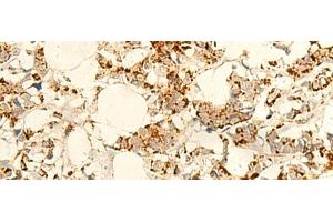 Immunohistochemistry of paraffin-embedded Human breast cancer tissue using NAPRT Polyclonal Antibody at dilution of 1:50(x200) (NAPRT1 antibody)