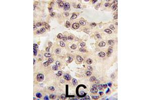 Formalin-fixed and paraffin-embedded human lung carcinoma tissue reacted with EN1 polyclonal antibody  , which was peroxidase-conjugated to the secondary antibody, followed by DAB staining.