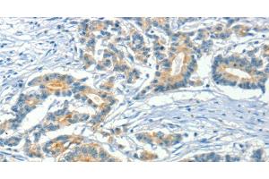 Immunohistochemistry of paraffin-embedded Human colon cancer using ASAH2 Polyclonal Antibody at dilution of 1:50 (ASAH2 antibody)