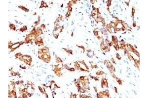 Formalin-fixed, paraffin-embedded human breast carcinoma stained with HSP27 antibody (HSPB1/774)