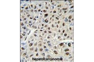 Formalin-fixed and paraffin-embedded human hepatocarcinoma reacted with SSB Antibody (C-term) (ABIN389303 and ABIN2839423) , which was peroxidase-conjugated to the secondary antibody, followed by DAB staining. (SSB antibody  (C-Term))