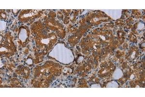 Immunohistochemistry of paraffin-embedded Human thyroid cancer tissue using MEIS1 Polyclonal Antibody at dilution 1:30 (MEIS1 antibody)