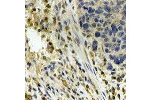 Immunohistochemical analysis of ALDH4A1 staining in human esophageal cancer formalin fixed paraffin embedded tissue section. (ALDH4A1 antibody)