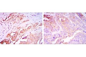 Immunohistochemical analysis of paraffin-embedded rectum cancer tissues (left) and stomach cancer tissues (right) using CEA mouse mAb with DAB staining. (CEA antibody)
