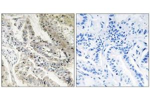 Immunohistochemistry analysis of paraffin-embedded human lung carcinoma tissue, using CRBP III antibody. (Retinol Binding Protein 5 antibody  (N-Term))