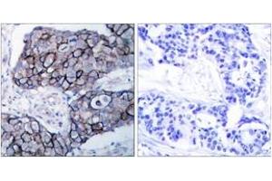 Immunohistochemistry analysis of paraffin-embedded human breast carcinoma tissue, using Integrin beta3 (Ab-785) Antibody. (Integrin beta 3 antibody  (AA 739-788))