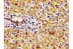 Immunohistochemistry of paraffin-embedded human liver cancer using ABIN7145059 at dilution of 1:100 (NPR3 antibody  (AA 36-127))