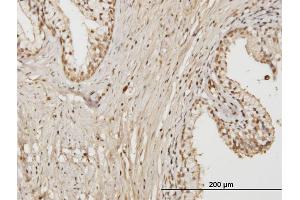 Immunoperoxidase of monoclonal antibody to RAB17 on formalin-fixed paraffin-embedded human prostate. (RAB17 antibody  (AA 1-212))