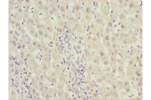 Immunohistochemistry of paraffin-embedded human liver cancer using ABIN7176530 at dilution of 1:100 (ZNF785 antibody  (AA 1-200))