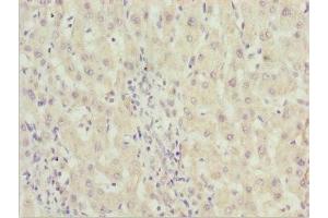 Immunohistochemistry of paraffin-embedded human liver cancer using ABIN7176530 at dilution of 1:100