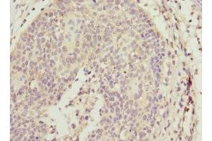 Immunohistochemistry of paraffin-embedded human cervical cancer using ABIN7143769 at dilution of 1:100 (ALG2 antibody  (AA 197-416))